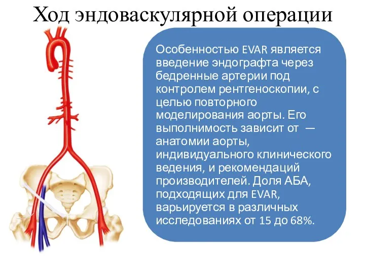 Ход эндоваскулярной операции