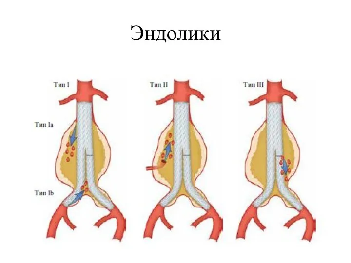 Эндолики