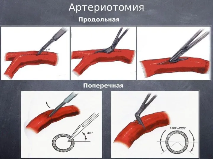 Артериотомия