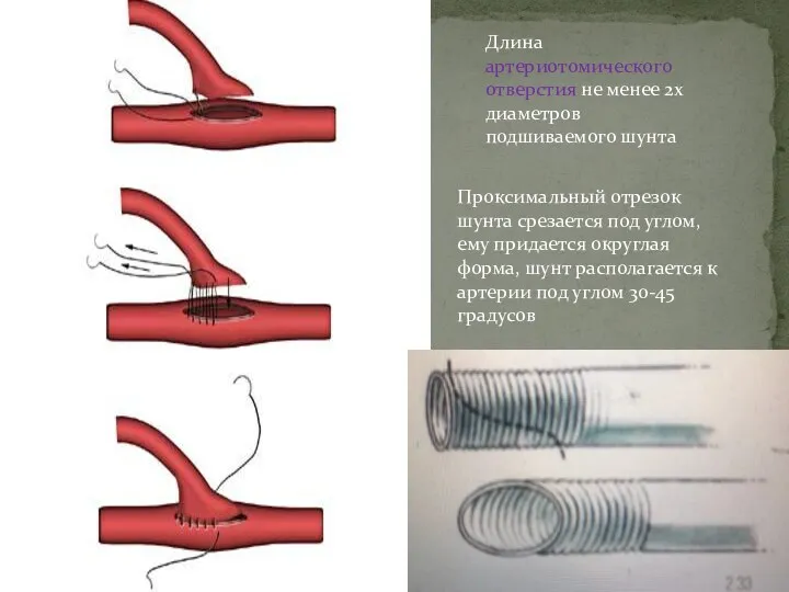 Длина артериотомического отверстия не менее 2х диаметров подшиваемого шунта Проксимальный