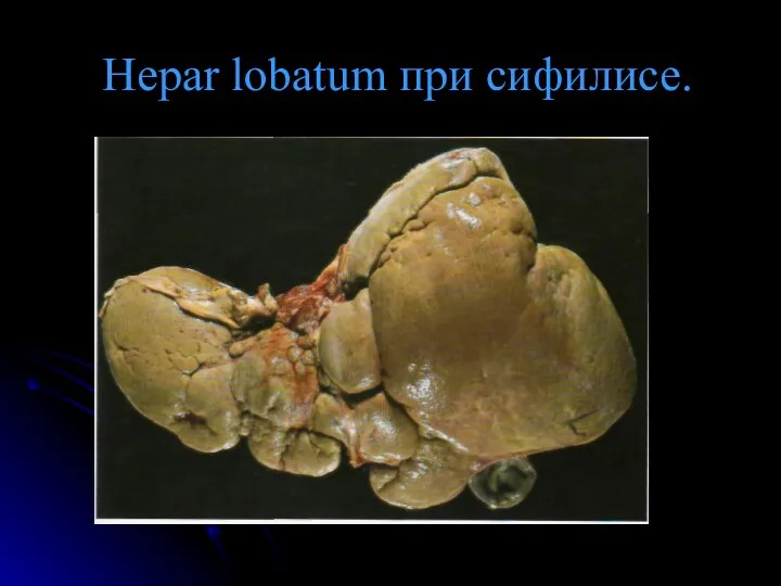 Hepar lobatum при сифилисе.