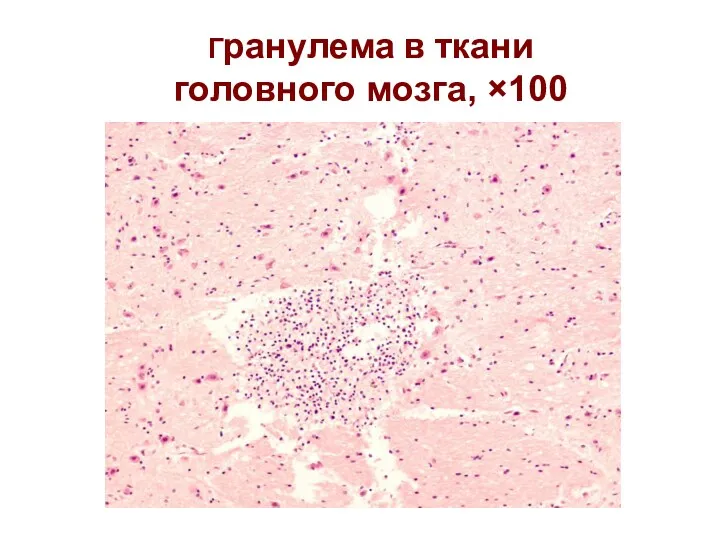 Гранулема в ткани головного мозга, ×100