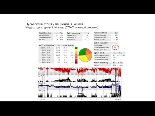 Пульсоксиметрия у пациента З., 49 лет. Индекс десатураций 46 в час (СОАС тяжелой степени)