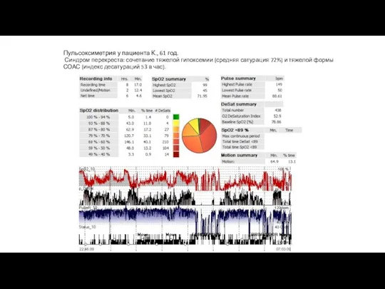 Пульсоксиметрия у пациента К., 61 год. Синдром перекреста: сочетание тяжелой