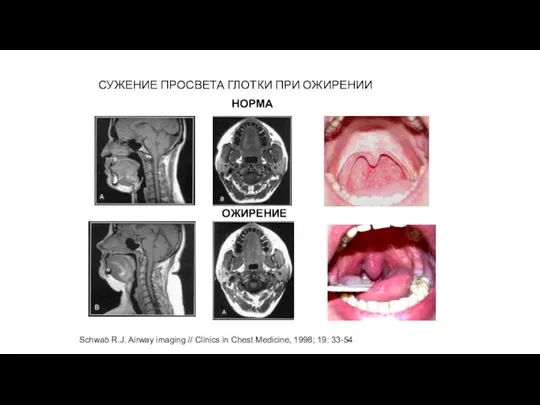 НОРМА ОЖИРЕНИЕ СУЖЕНИЕ ПРОСВЕТА ГЛОТКИ ПРИ ОЖИРЕНИИ Schwab R.J. Airway