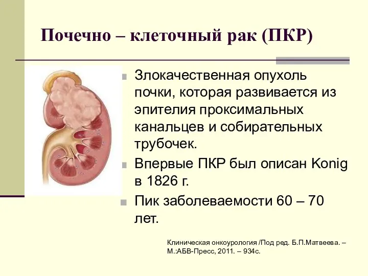 Почечно – клеточный рак (ПКР) Злокачественная опухоль почки, которая развивается