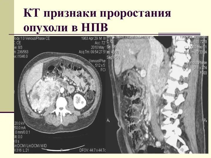 КТ признаки проростания опухоли в НПВ