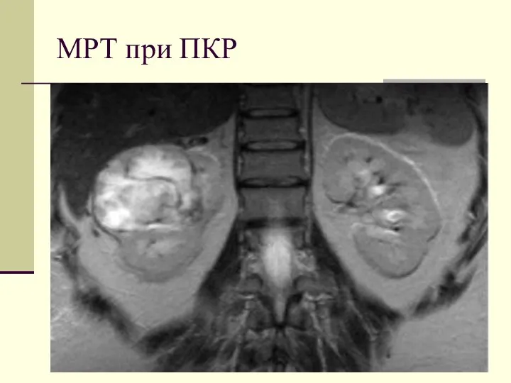 МРТ при ПКР
