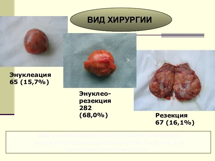 Энуклеация 65 (15,7%) Энуклео-резекция 282 (68,0%) Резекция 67 (16,1%) ВИД ХИРУРГИИ Еще у