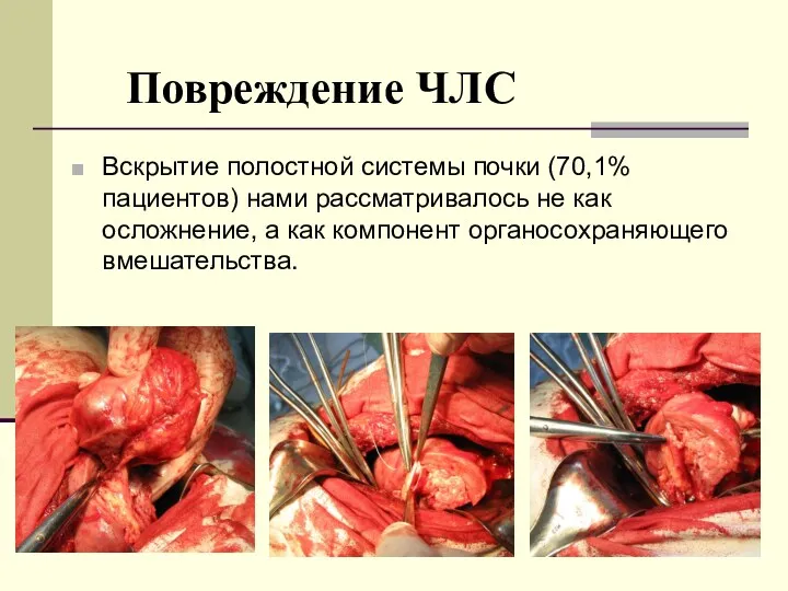 Повреждение ЧЛС Вскрытие полостной системы почки (70,1% пациентов) нами рассматривалось