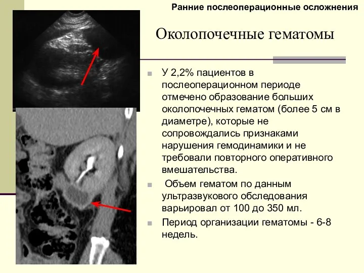 Околопочечные гематомы У 2,2% пациентов в послеоперационном периоде отмечено образование