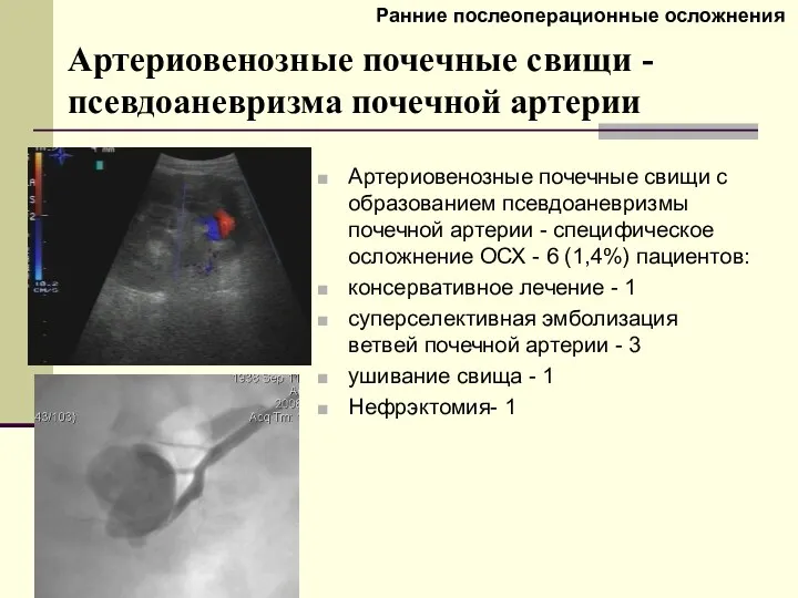 Артериовенозные почечные свищи -псевдоаневризма почечной артерии Артериовенозные почечные свищи с образованием псевдоаневризмы почечной