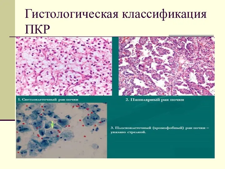 Гистологическая классификация ПКР