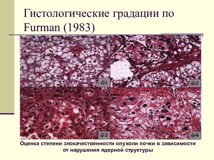 Гистологические градации по Furman (1983) Оценка степени злокачественности опухоли почки в зависимости от нарушения ядерной структуры