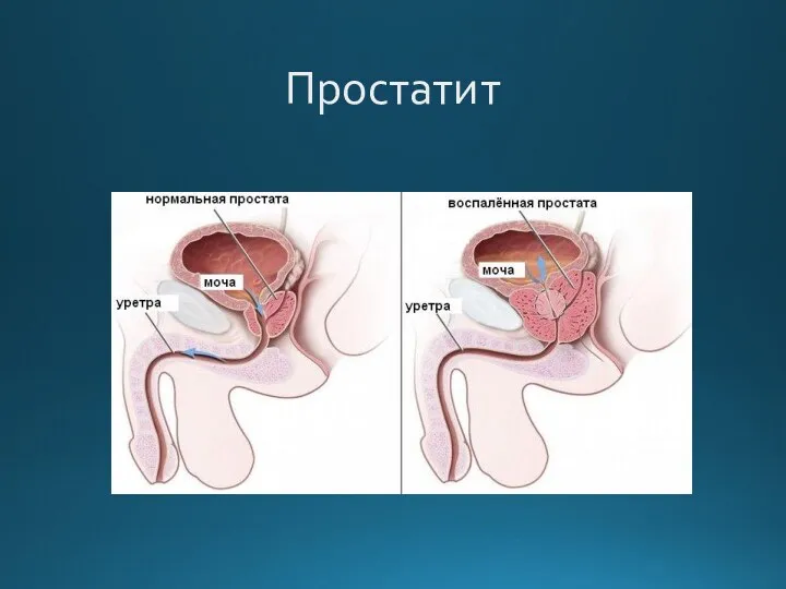 Простатит