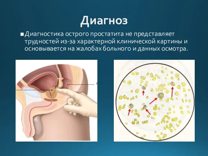 Диагноз Диагностика острого простатита не представляет трудностей из-за характерной клинической