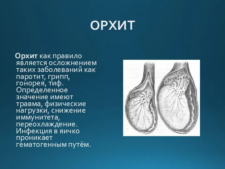 ОРХИТ Орхит как правило является осложнением таких заболеваний как паротит,