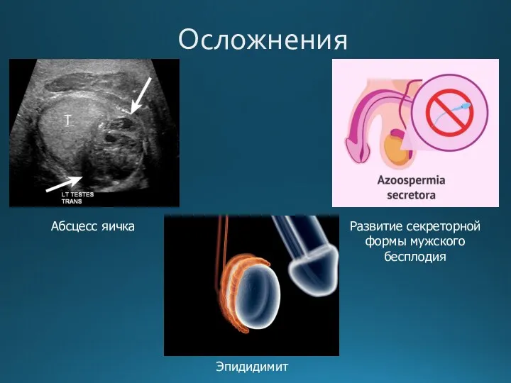 Осложнения Абсцесс яичка Развитие секреторной формы мужского бесплодия Эпидидимит