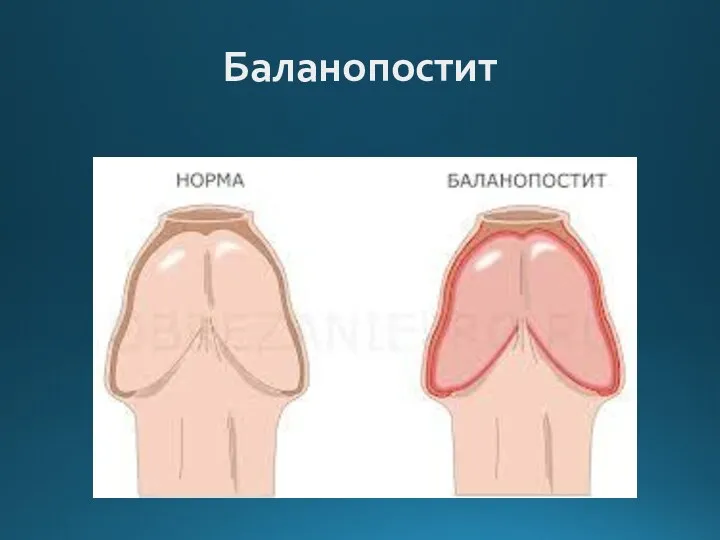 Баланопостит