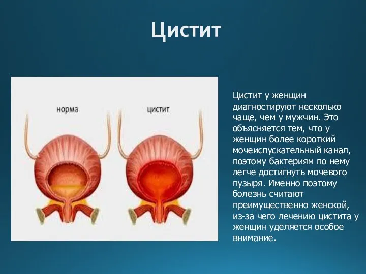 Цистит Цистит у женщин диагностируют несколько чаще, чем у мужчин.