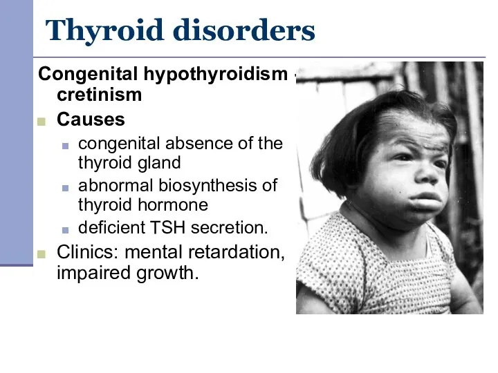 Thyroid disorders Congenital hypothyroidism - cretinism Causes congenital absence of