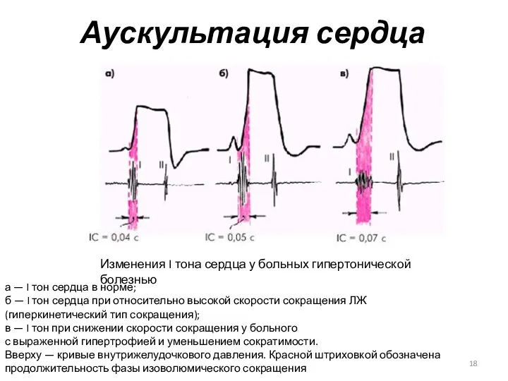 Аускультация сердца Изменения I тона сердца у больных гипертонической болезнью а — I