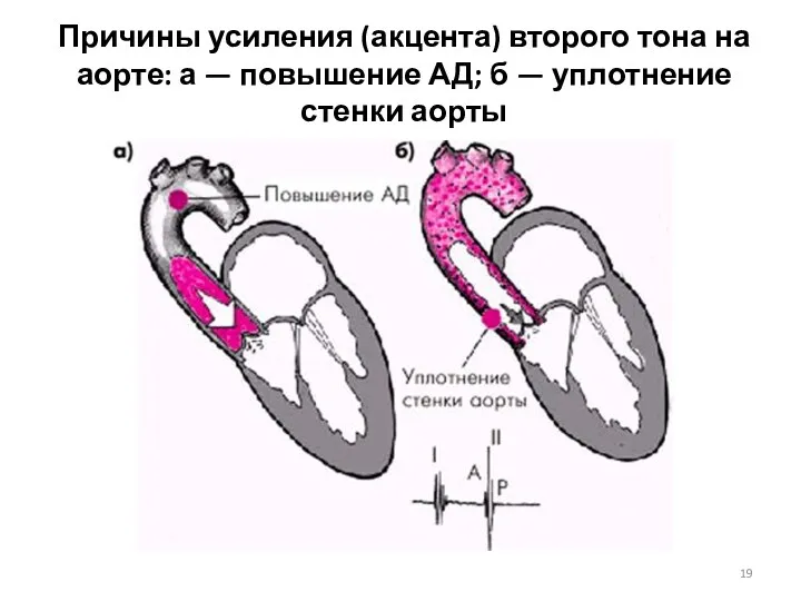 Причины усиления (акцента) второго тона на аорте: а — повышение АД; б — уплотнение стенки аорты