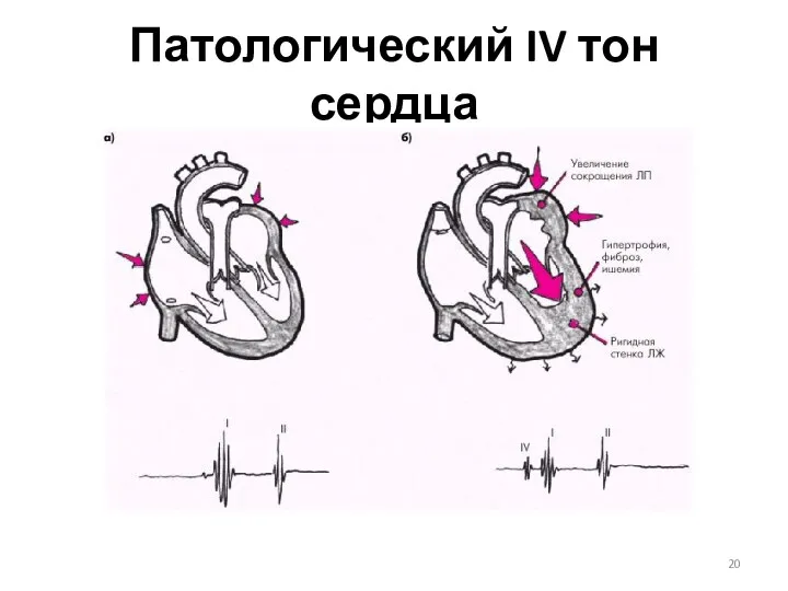 Патологический IV тон сердца
