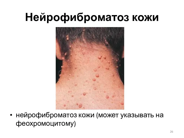 Нейрофиброматоз кожи нейрофиброматоз кожи (может указывать на феохромоцитому)