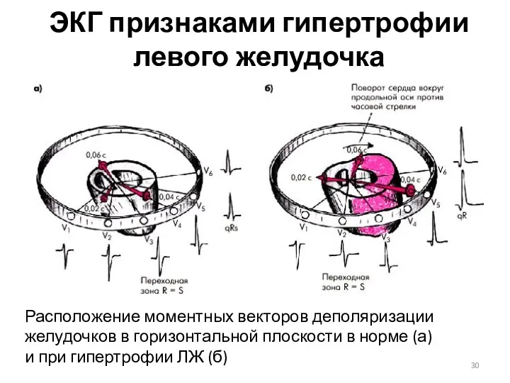 ЭКГ признаками гипертрофии левого желудочка Расположение моментных векторов деполяризации желудочков в горизонтальной плоскости