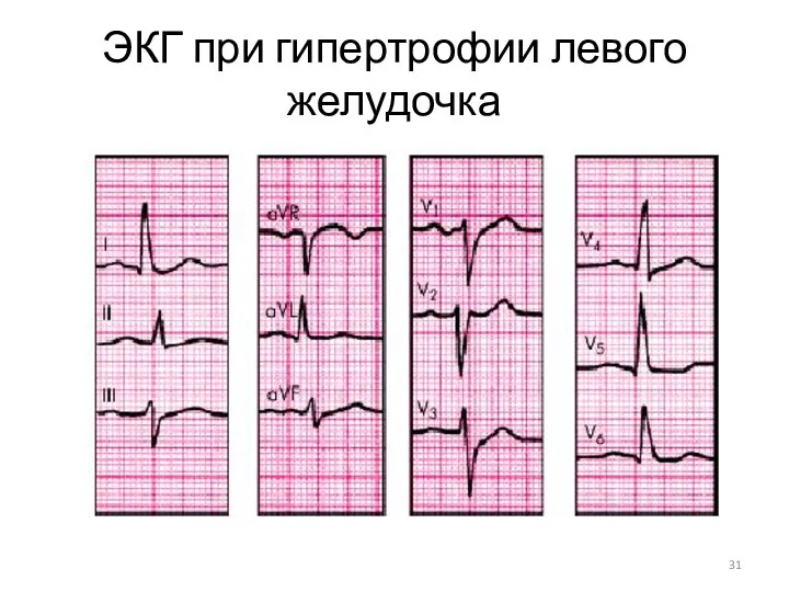 ЭКГ при гипертрофии левого желудочка