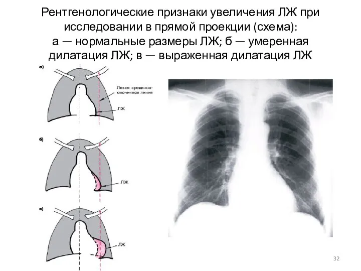 Рентгенологические признаки увеличения ЛЖ при исследовании в прямой проекции (схема): а — нормальные