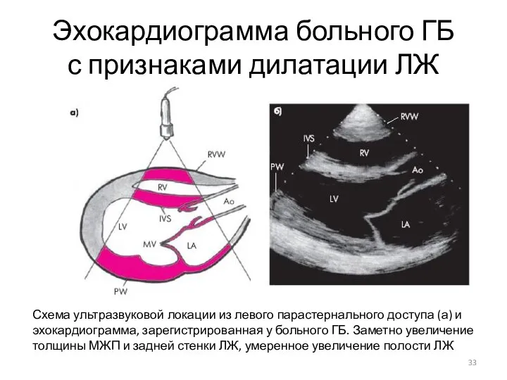 Эхокардиограмма больного ГБ с признаками дилатации ЛЖ Схема ультразвуковой локации из левого парастернального