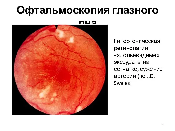 Офтальмоскопия глазного дна Гипертоническая ретинопатия: «хлопьевидные» экссудаты на сетчатке, сужение артерий (по J.D. Swales)
