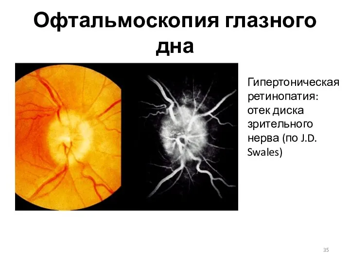 Офтальмоскопия глазного дна Гипертоническая ретинопатия: отек диска зрительного нерва (по J.D. Swales)