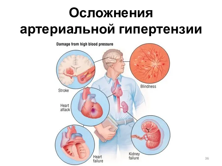 Осложнения артериальной гипертензии