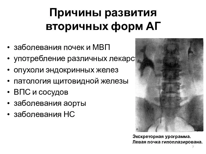 Причины развития вторичных форм АГ заболевания почек и МВП употребление различных лекарств опухоли