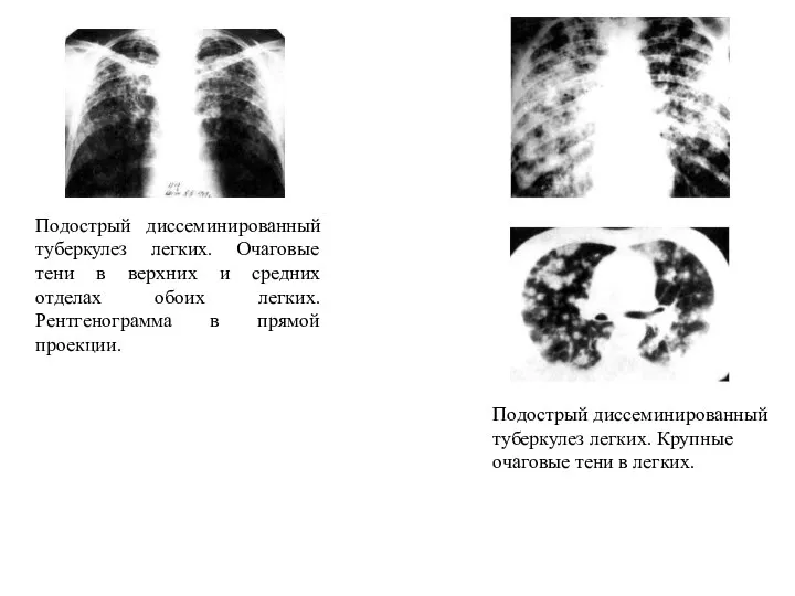 Подострый диссеминированный туберкулез легких. Очаговые тени в верхних и средних