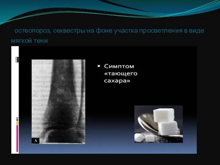 остеопороз, секвестры на фоне участка просветления в виде мягкой тени