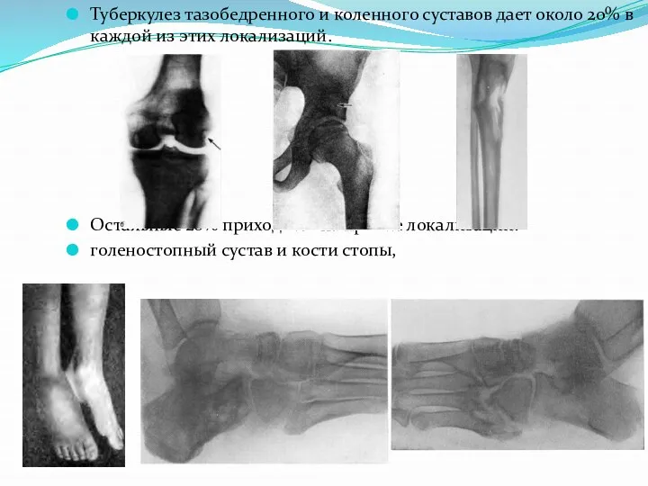 Туберкулез тазобедренного и коленного суставов дает около 20% в каждой