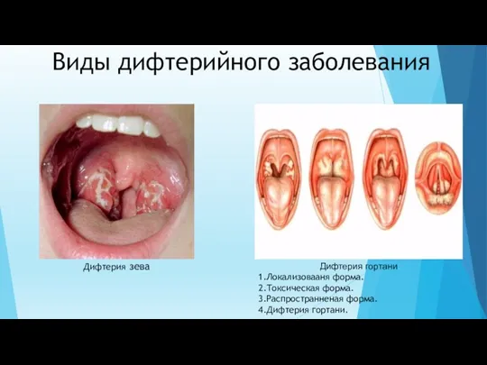 Виды дифтерийного заболевания Дифтерия зева Дифтерия гортани 1.Локализовааня форма. 2.Токсическая форма. 3.Распространненая форма. 4.Дифтерия гортани.