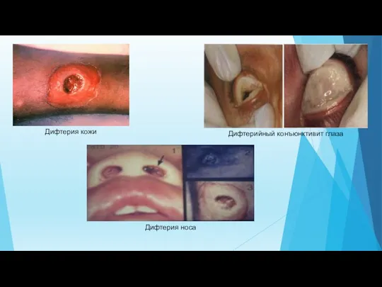 Дифтерия кожи Дифтерийный конъюнктивит глаза Дифтерия носа
