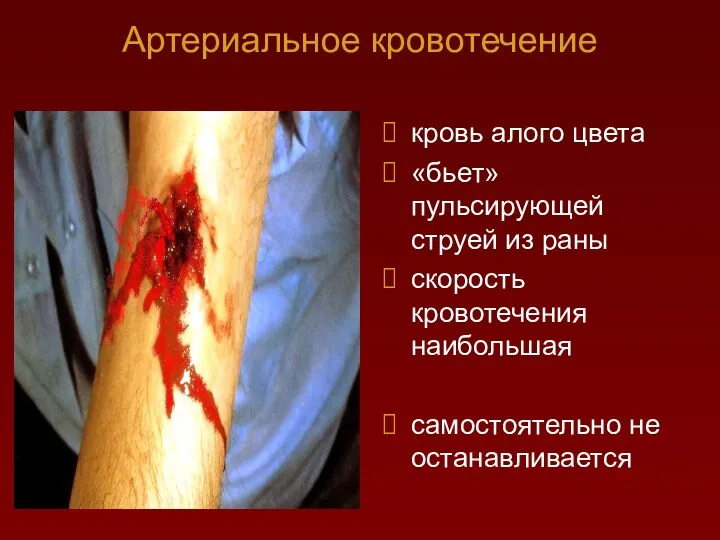 Артериальное кровотечение кровь алого цвета «бьет» пульсирующей струей из раны скорость кровотечения наибольшая самостоятельно не останавливается