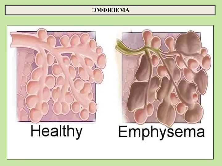 ЭМФИЗЕМА