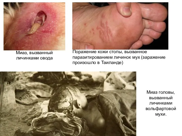 Миаз, вызванный личинками овода Поражение кожи стопы, вызванное паразитированием личинок