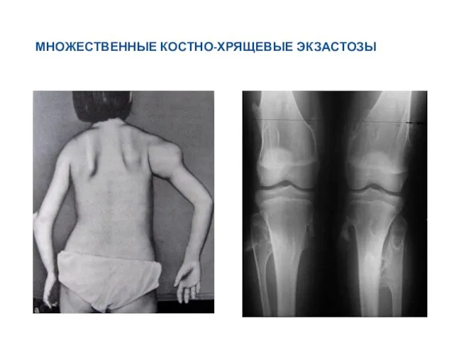 МНОЖЕСТВЕННЫЕ КОСТНО-ХРЯЩЕВЫЕ ЭКЗАСТОЗЫ