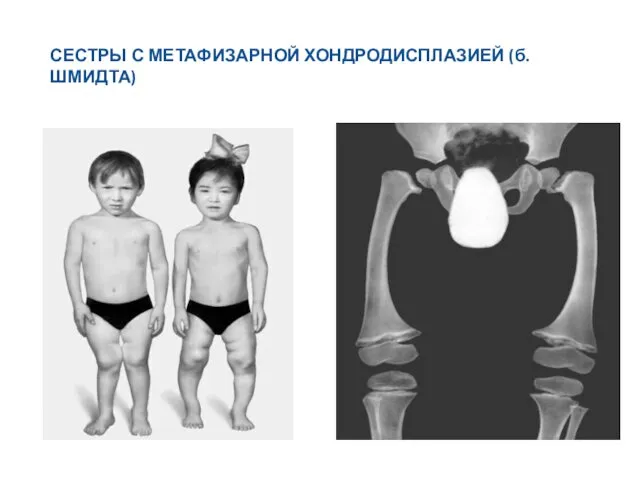 СЕСТРЫ С МЕТАФИЗАРНОЙ ХОНДРОДИСПЛАЗИЕЙ (б. ШМИДТА)