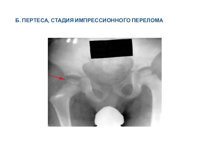 Б. ПЕРТЕСА, СТАДИЯ ИМПРЕССИОННОГО ПЕРЕЛОМА