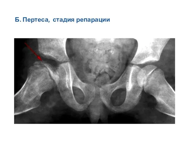 Б. Пертеса, стадия репарации