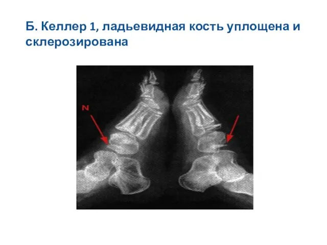 Б. Келлер 1, ладьевидная кость уплощена и склерозирована